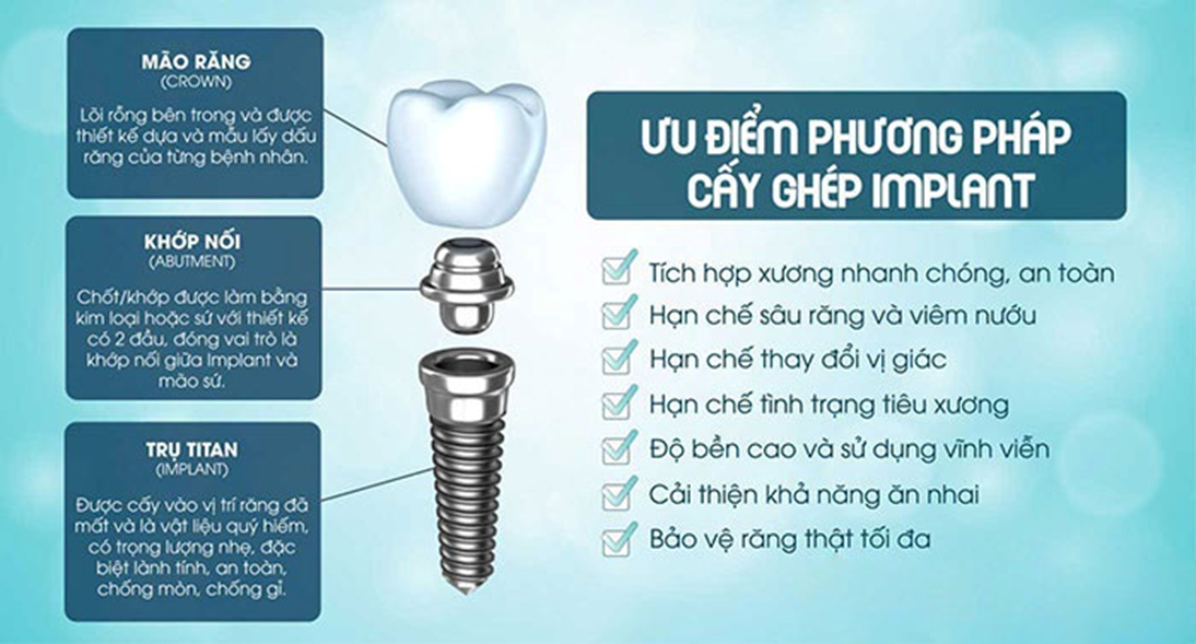 Phương Pháp Trồng ( Cấy Ghép ) Răng Implant