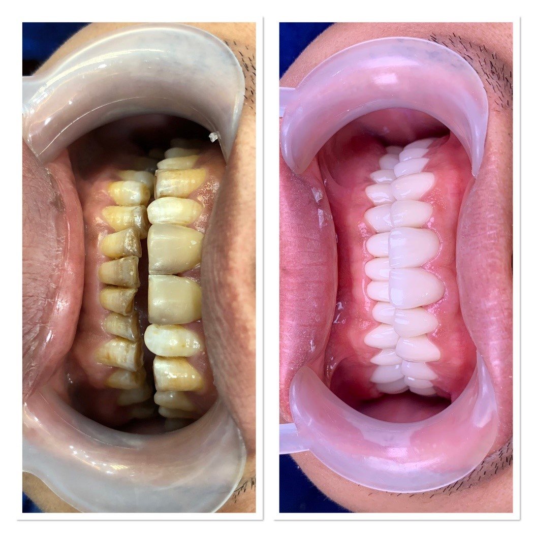 BẢNG GIÁ BỌC RĂNG SỨ THẨM MỸ TẠI NHA KHOA TÂM VIỆT