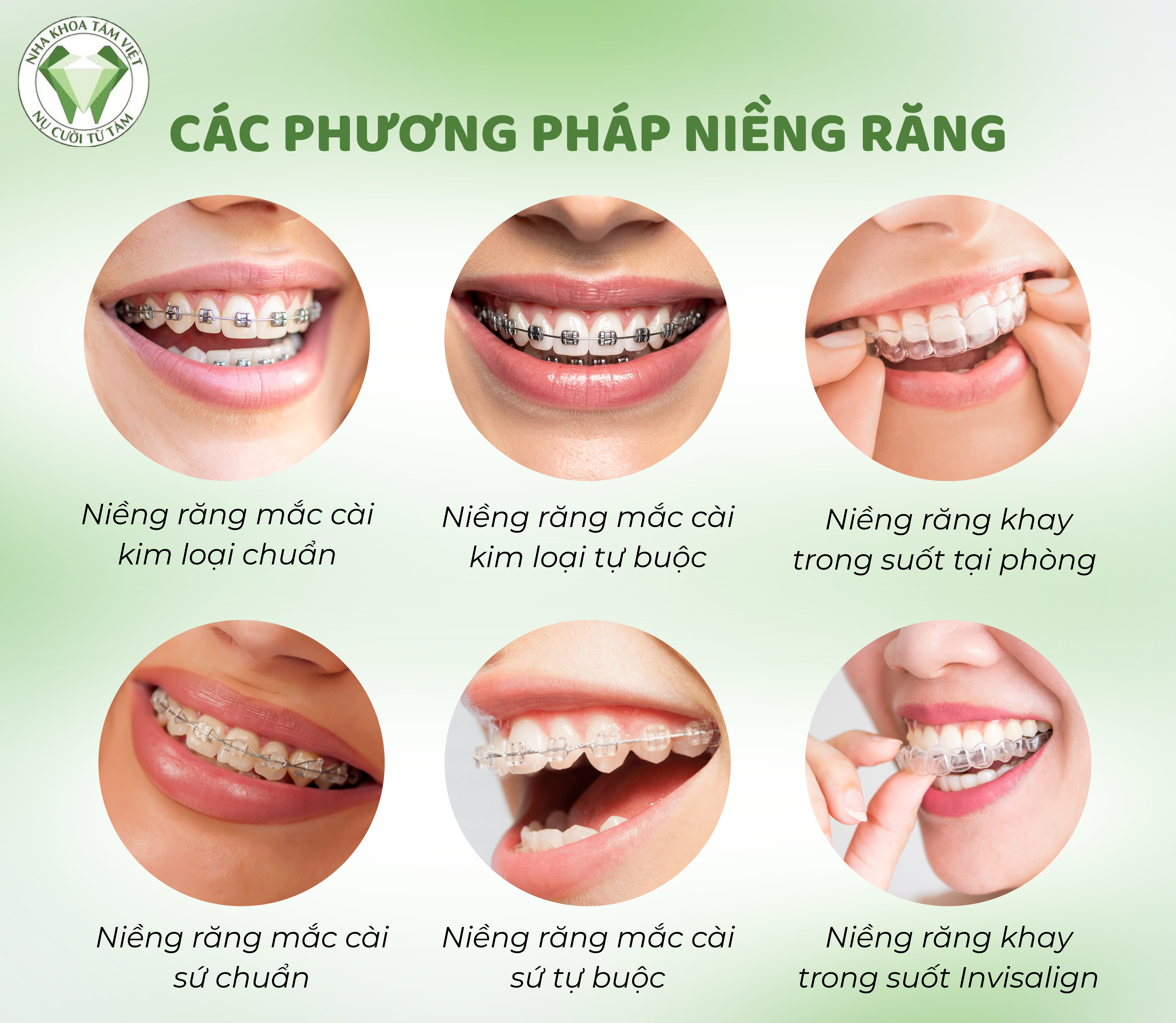 CHỈNH NHA UY TÍN – CHÌA KHÓA MANG LẠI NỤ CƯỜI TỰ TIN TẠI NHA KHOA TÂM VIỆT