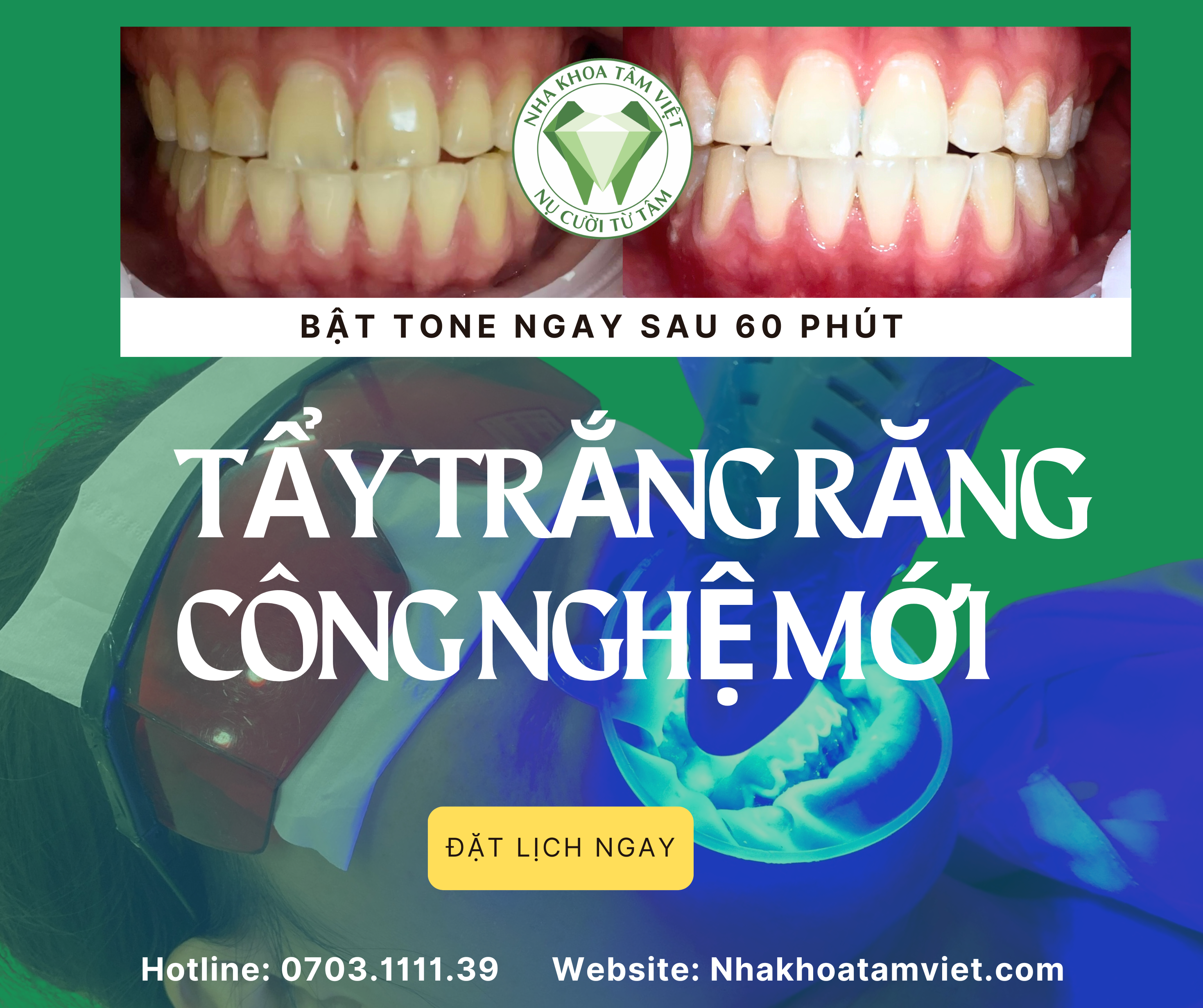 TẨY TRẮNG RĂNG: BÍ QUYẾT ĐỂ NỤ CƯỜI SÁNG BỀN LÂU TẠI NHA KHOA TÂM VIỆT