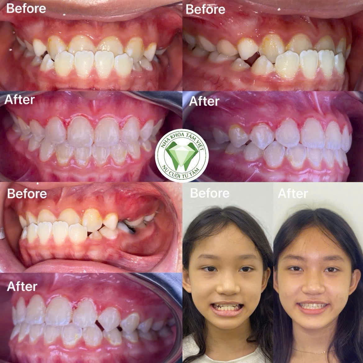 NIỀNG RĂNG TPHCM – HÀNH TRÌNH KIẾN TẠO NỤ CƯỜI ĐẸP CÙNG NHA KHOA TÂM VIỆT