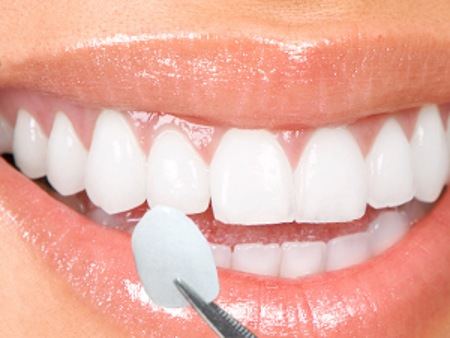 Răng sứ thẩm mỹ - Bọc răng sứ Cercon
